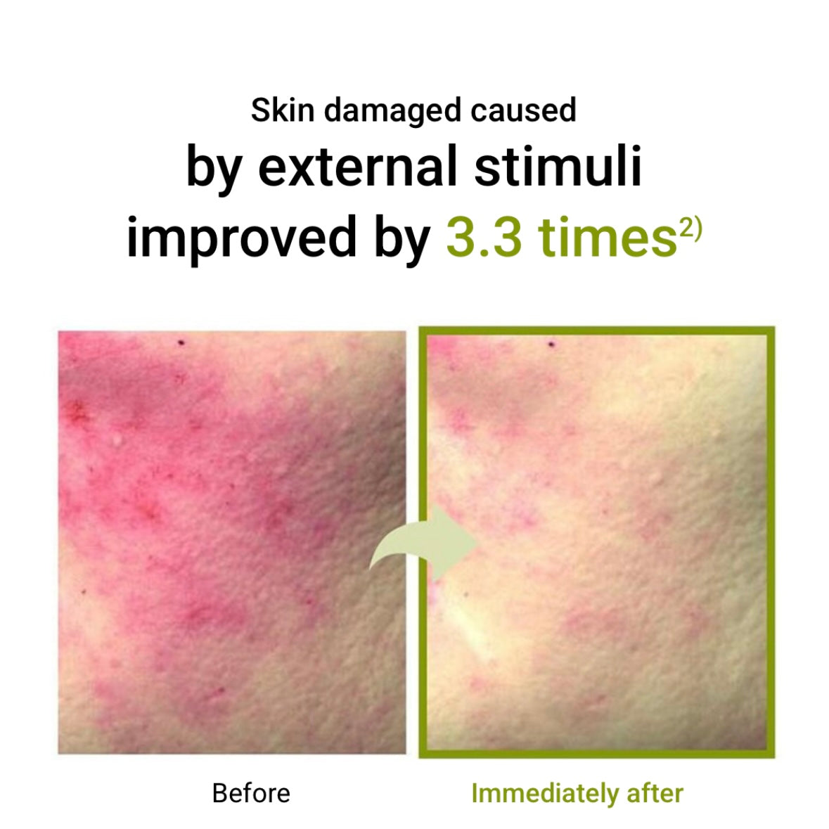 韓國皮膚科醫生推薦️!! ZEROID Intensive Cream 80ml (+50ml)