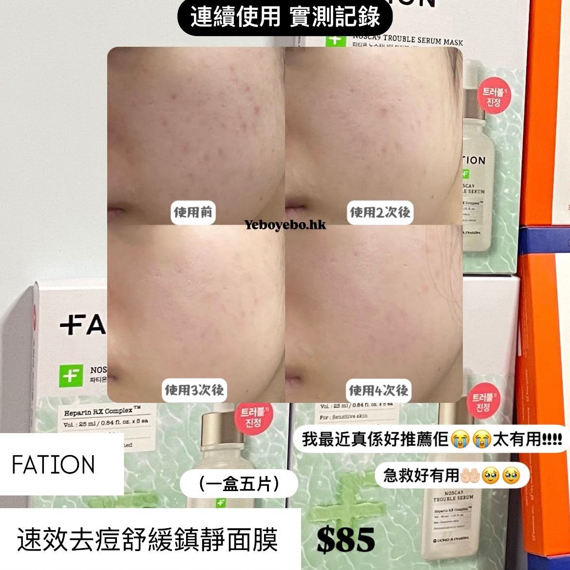 Fation東亞藥廠出品 速效去痘舒緩鎮靜面膜 (一盒5片)￼
